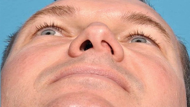 سپتوپلاستی در اصفهان | درمان انحراف بینی و مشکلات تنفسی