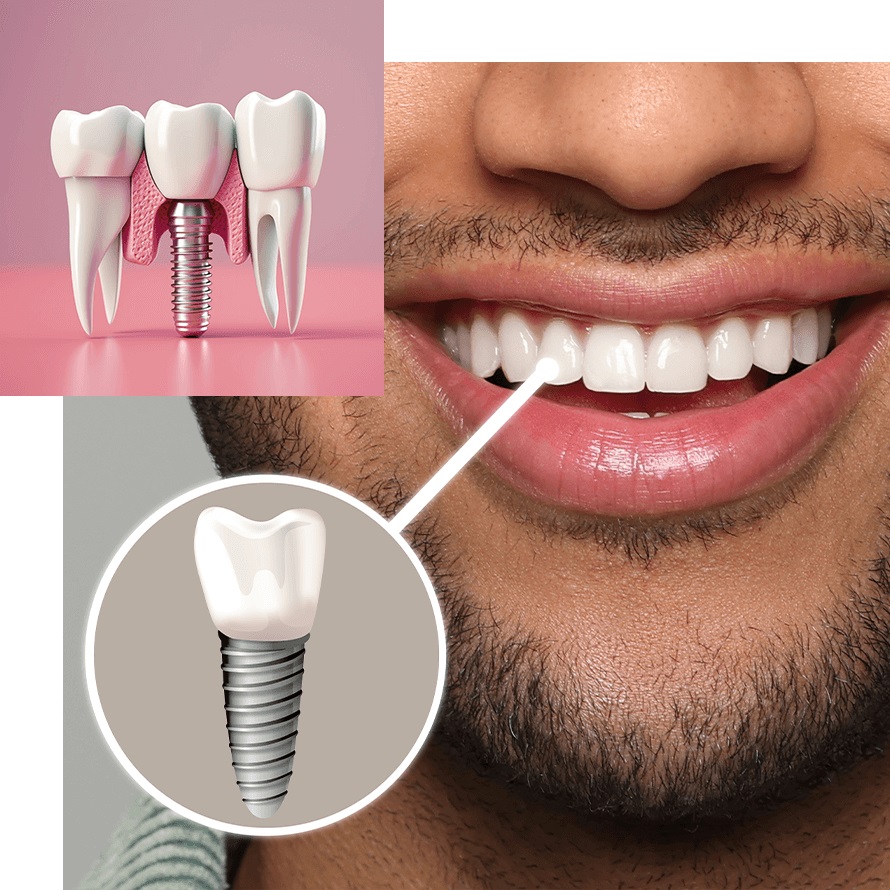 ایمپلنت فوری چیست؟ | مزایا، معایب و شرایط انجام