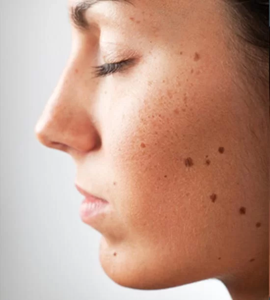 سوزاندن خال بزرگ