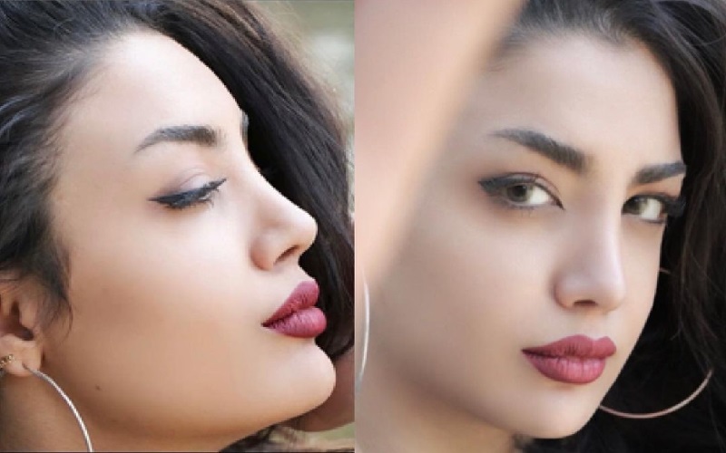 جراحی زیبایی بینی ( رینوپلاستی)