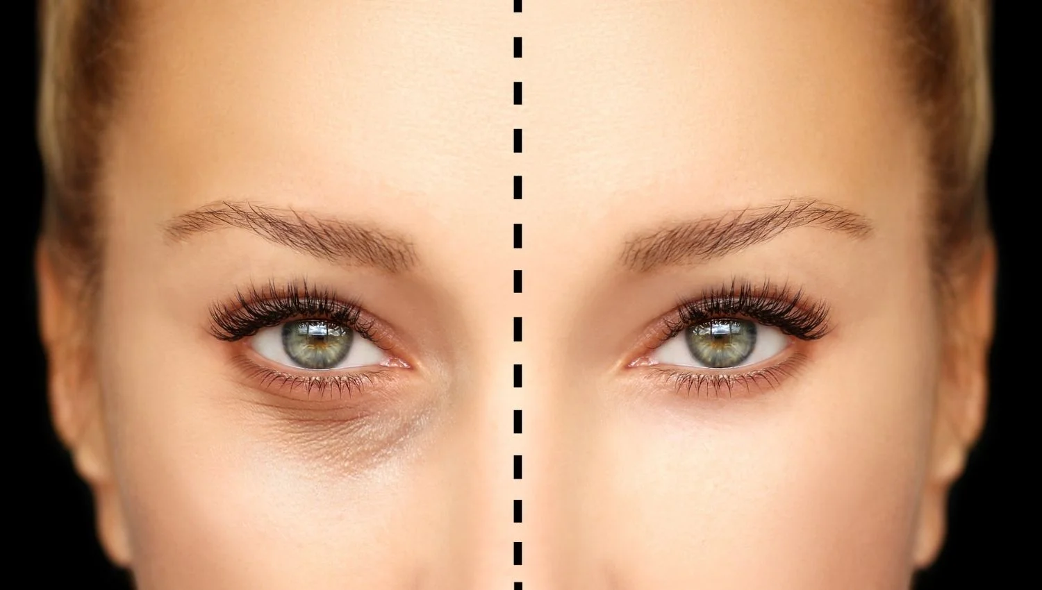 آینده بوتاکس و فناوریهای نوین در جوانسازی پوست