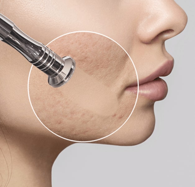 میکرودرم ابریژن